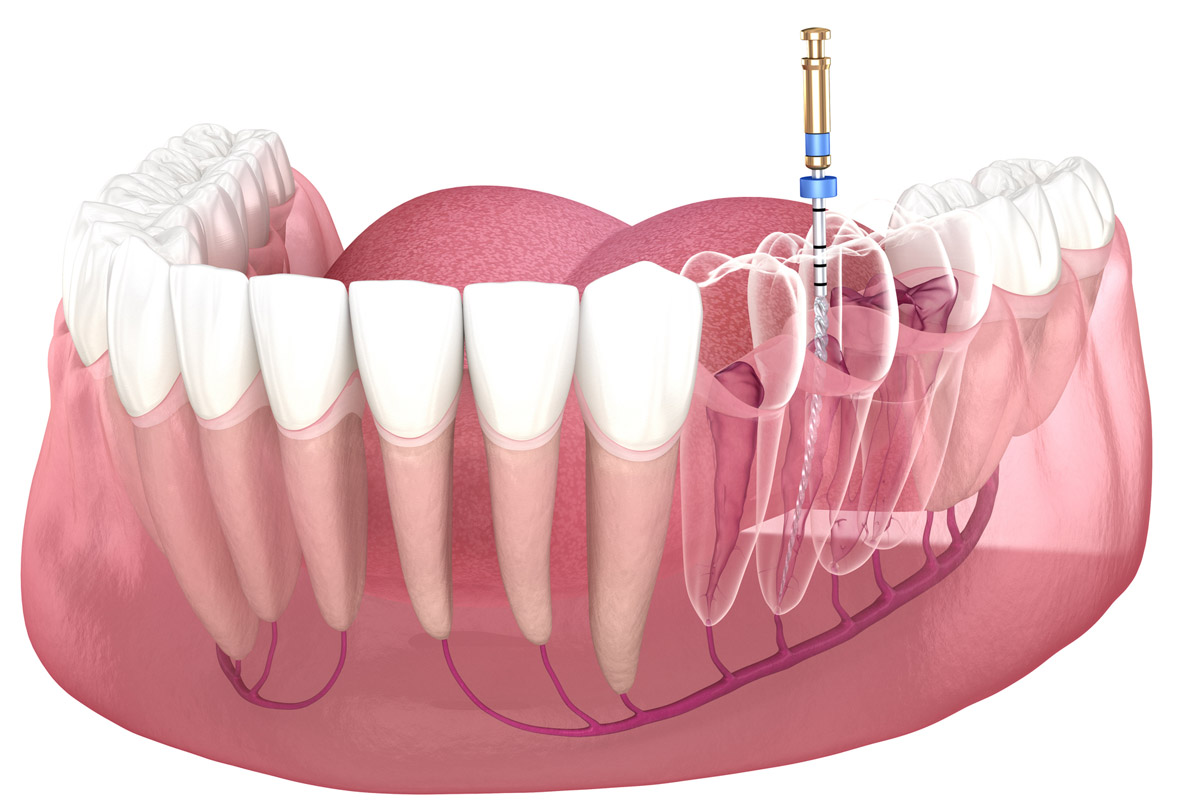 Strojna tehnika liječenja zuba (strojna endodoncija)